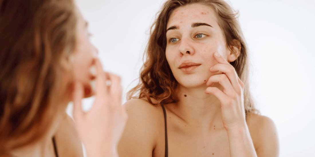 Oily Skin: Do You Really Need a Moisturizer ?
