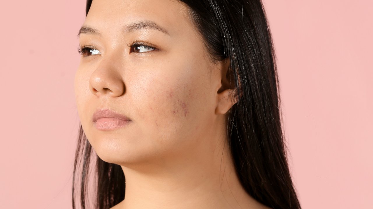 Oily & acne-prone skin