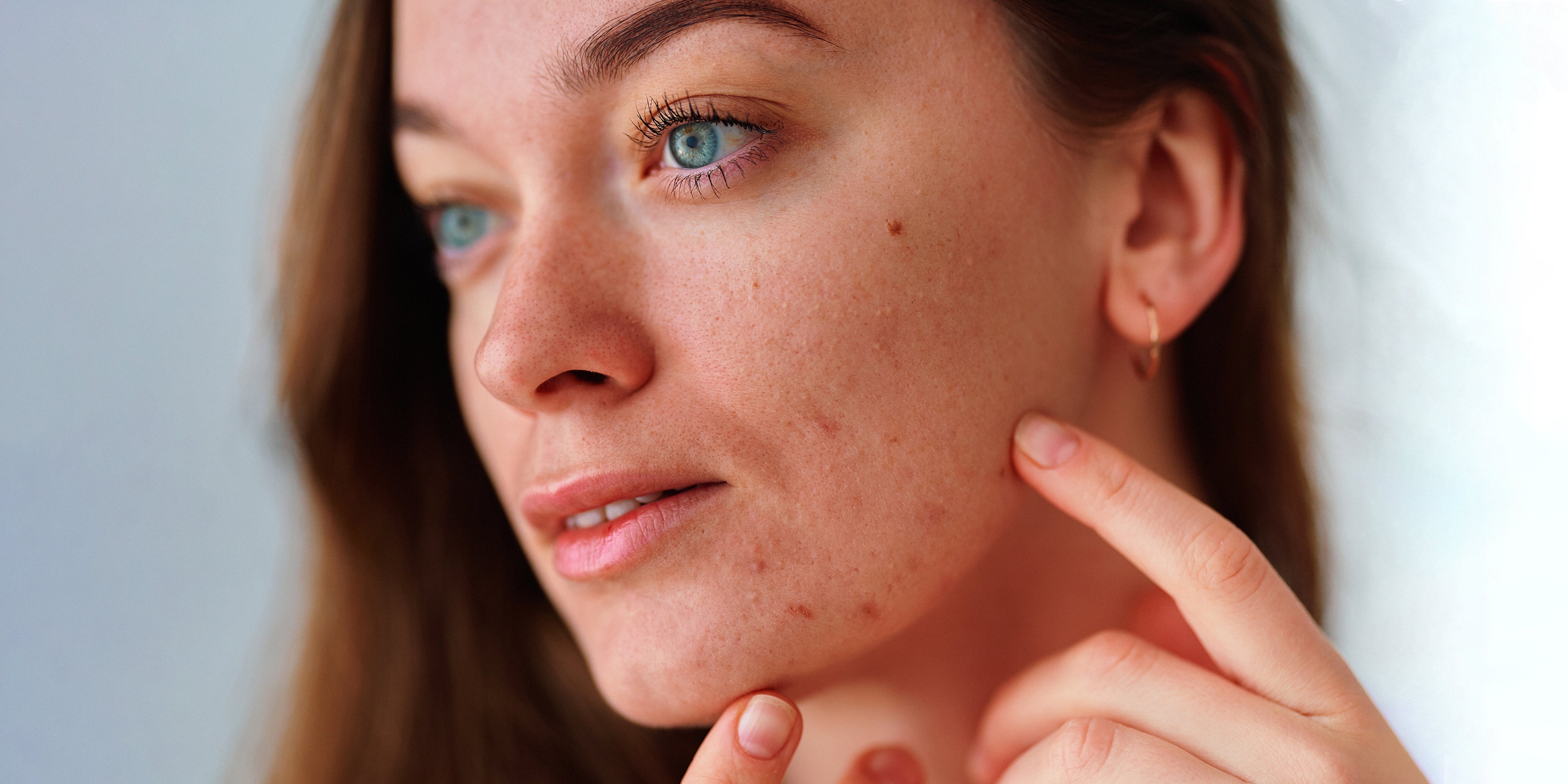 Acne & blemishes